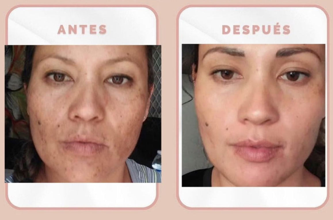 Crema Despigmentante